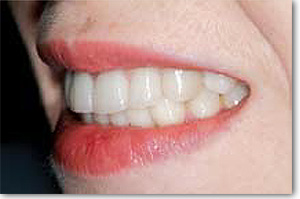 Citydental-Labor PRETTAU® ZIRKON
