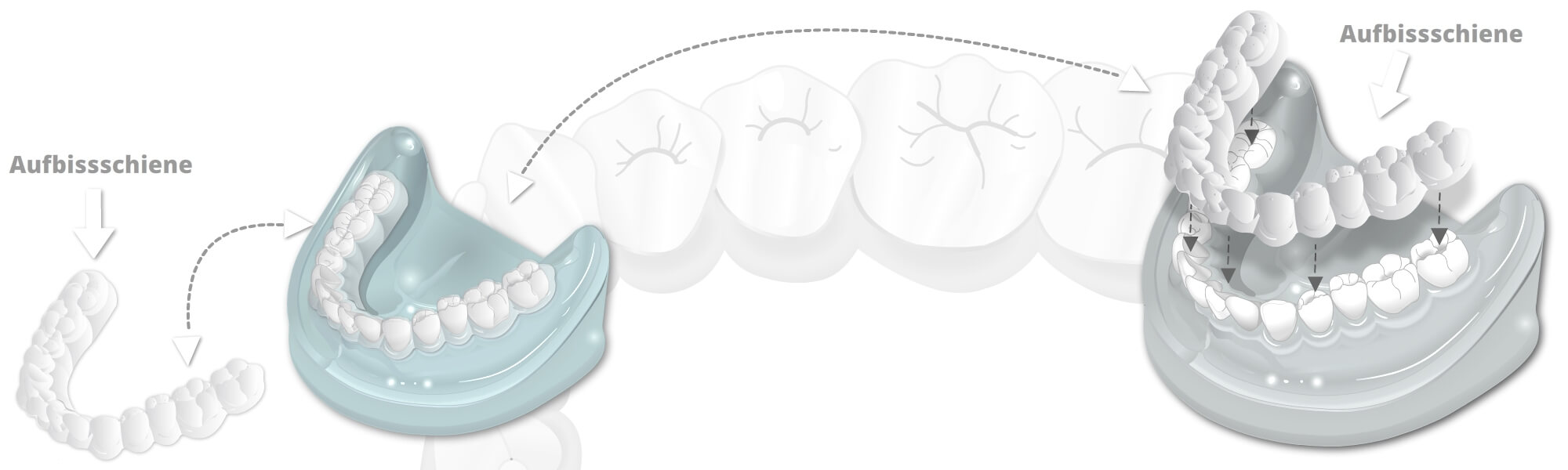 City Dental Labor - Illustration Aufbissschiene, Knirschschiene, Sportschutz oder Laserschweißtechnik