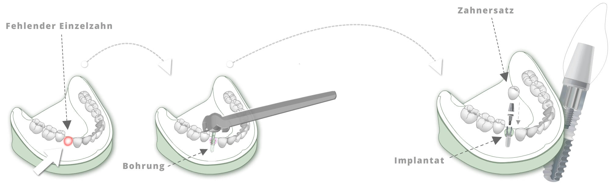 City Dental Labor - Illustration Einzelzahnversorgungk
