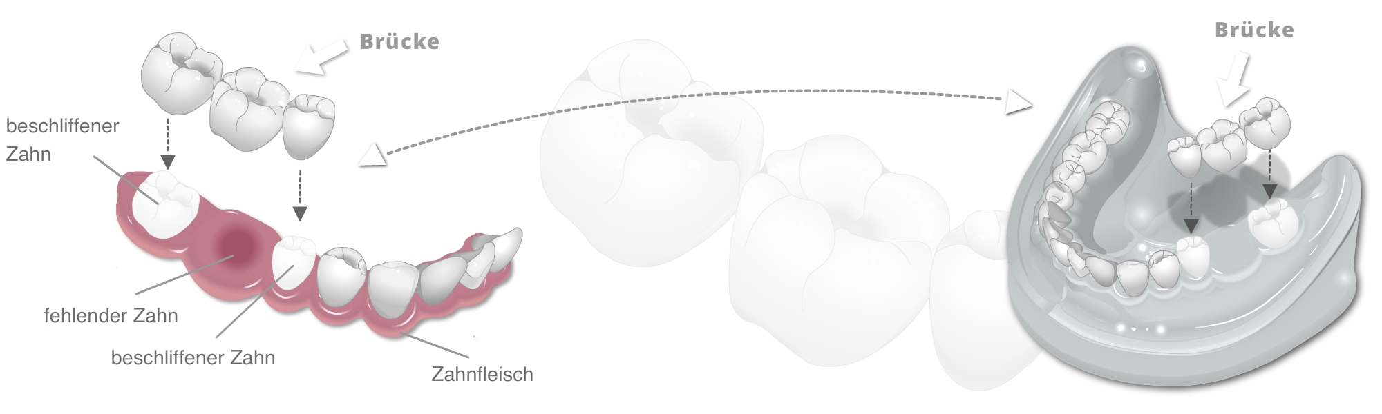 Schematische Darstellung einer festsitzenden Brücke mit beschliffenen Zähnen und fehlendem Zahn.