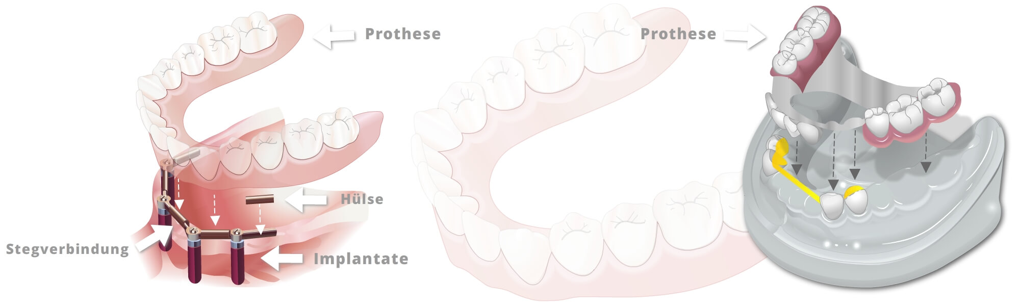 Schematische Darstellung einer implantatgetragenen Prothese mit Stegverbindung, Hülsen und eingesetzter Prothese auf dem Unterkiefermodell.