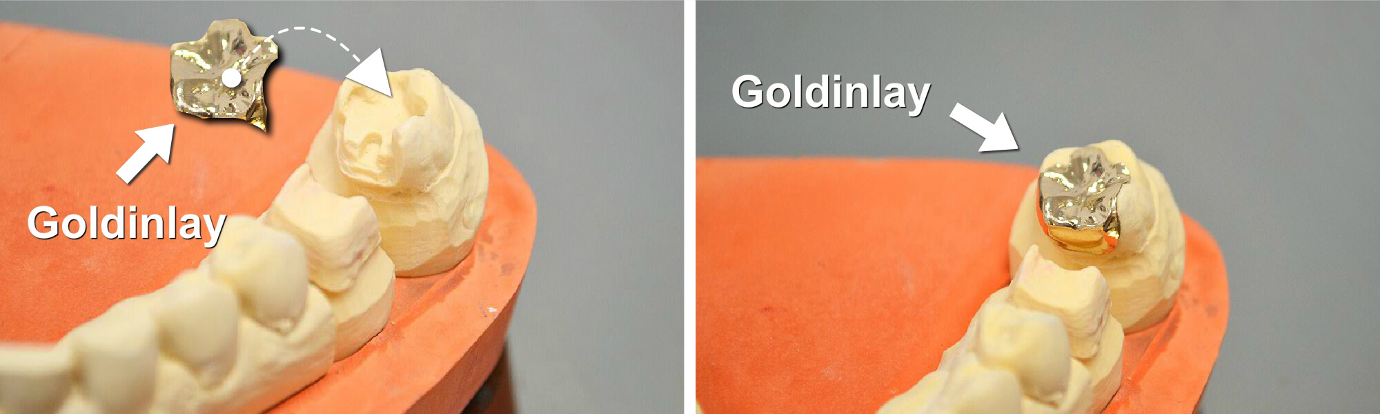 Goldinlay auf einem Zahnmodell vor und nach dem Einsetzen in einen präparierten Zahn.
