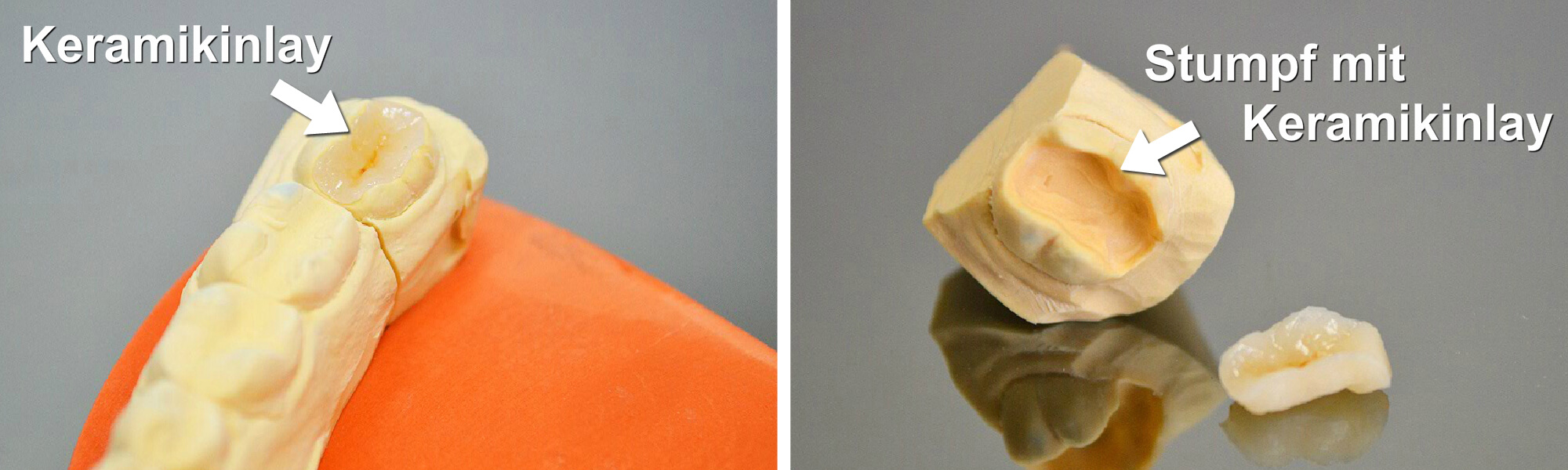 Keramikinlay auf einem Zahnmodell sowie separater Zahnstumpf mit passendem Keramikinlay.