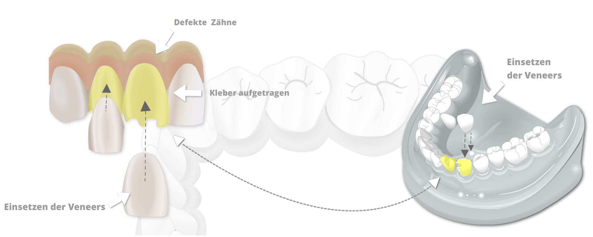Schematische Darstellung von Veneers mit defekten Zähnen, aufgetragenem Kleber und dem Einsetzen der Veneers.