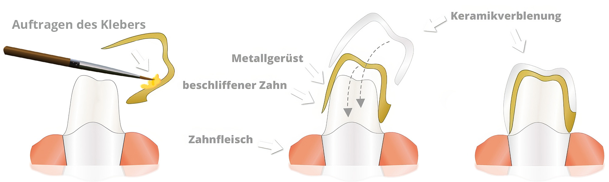Schematische Darstellung einer Keramikverblendkrone mit Kleberauftrag, Metallgerüst, beschliffenem Zahn und Keramikverblendung.