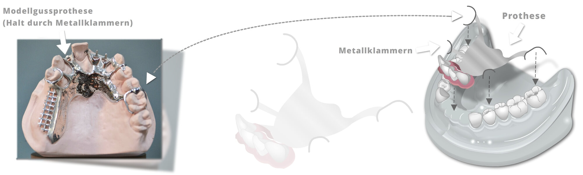 Schematische Darstellung einer Modellgussprothese mit Metallklammern zur Befestigung auf einem Zahnmodell.