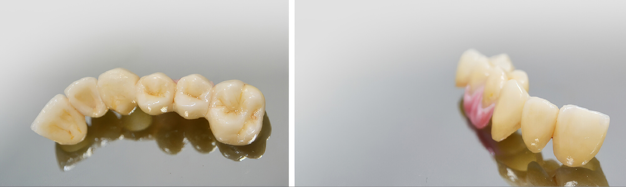City Dental Labor - Prettau® Zirkon steht für hochwertigen vollkeramischen Zahnersatz