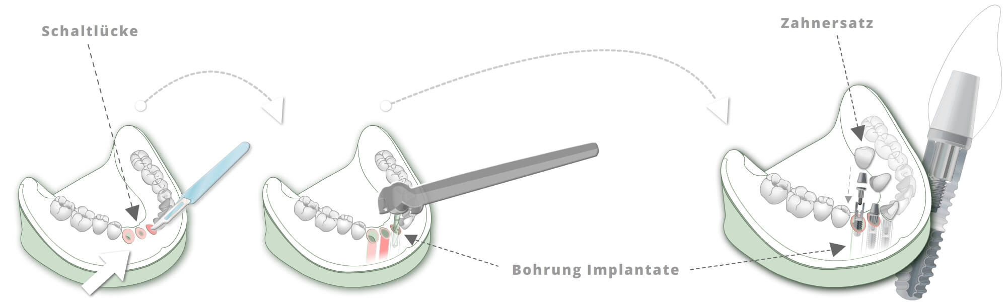 Schematische Darstellung einer implantatgetragenen Versorgung bei Schaltlücke mit Bohrung, Implantaten und eingesetztem Zahnersatz.