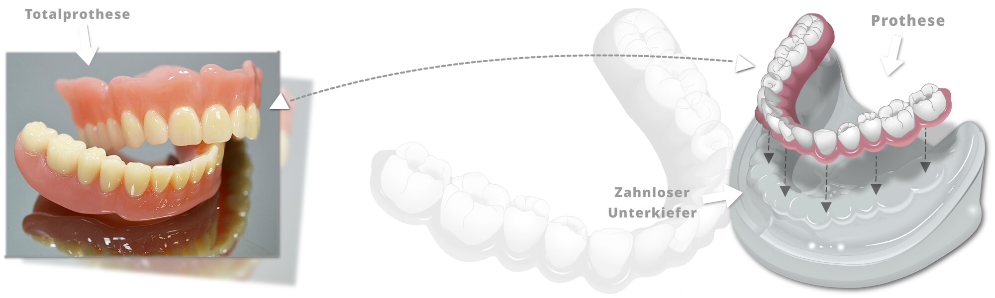 Darstellung einer Totalprothese für einen zahnlosen Unterkiefer mit eingesetzter Prothese auf einem Zahnmodell.