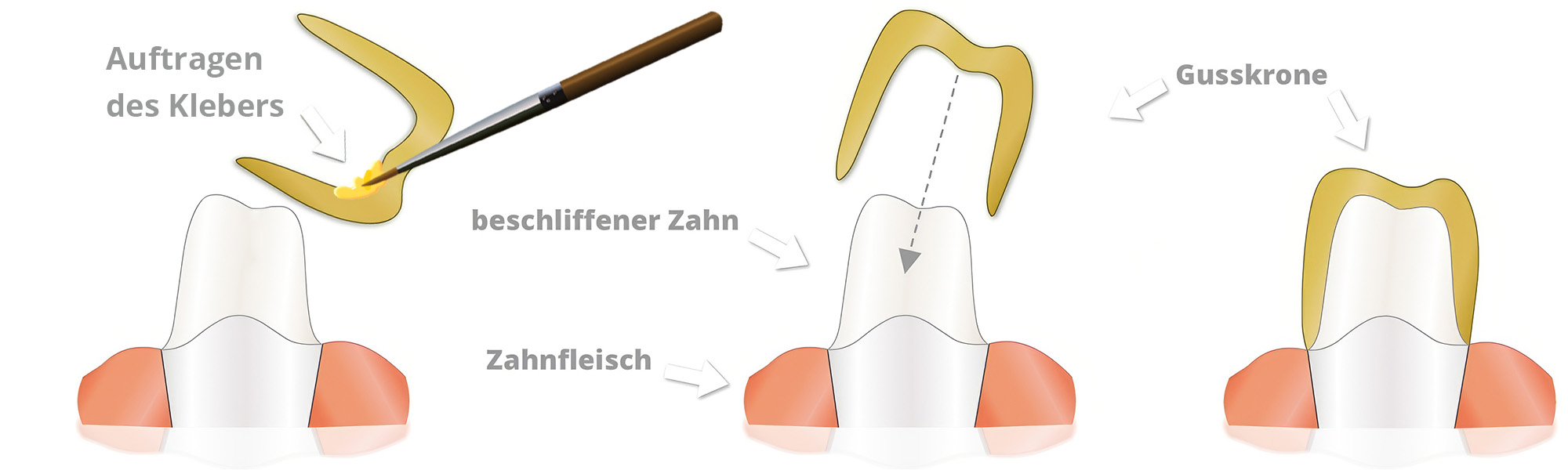 Schematische Darstellung einer Vollgusskrone mit Kleberauftrag, beschliffenem Zahn und eingesetzter Gusskrone.