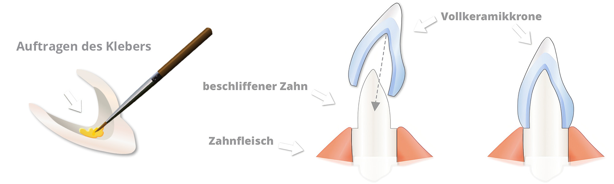 Schematische Darstellung einer Vollkeramikkrone mit Kleberauftrag, beschliffenem Zahn und eingesetzter Keramikkrone.