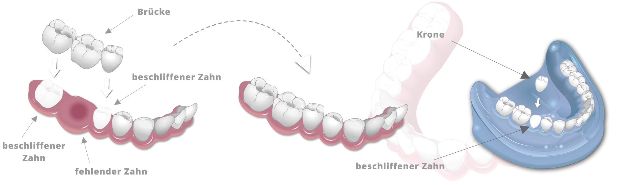 Schematische Darstellung einer Brücke und Krone mit beschliffenen Zähnen, fehlendem Zahn und eingesetztem Zahnersatz im Unterkiefermodell.
