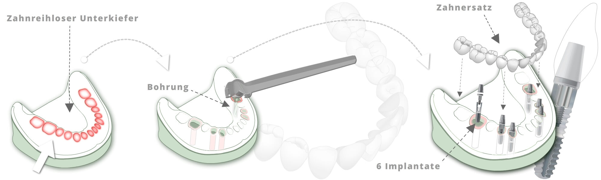City Dental Labor - Illustration Versorgung des unbezahnten Kiefers
