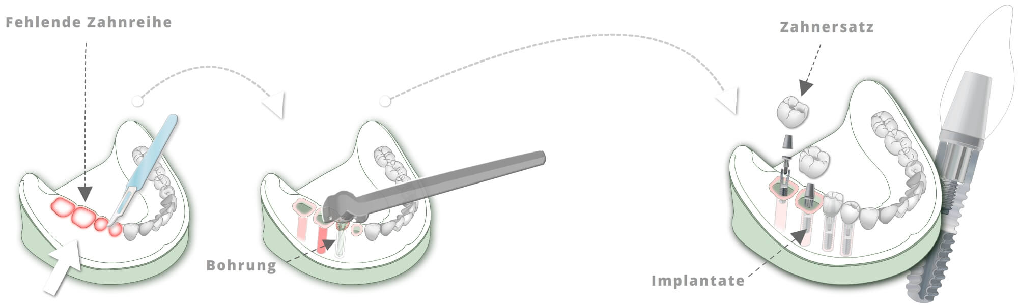 Schematische implantatgetragene Versorgung einer fehlenden Zahnreihe mit Bohrung, Implantaten und eingesetztem Zahnersatz.