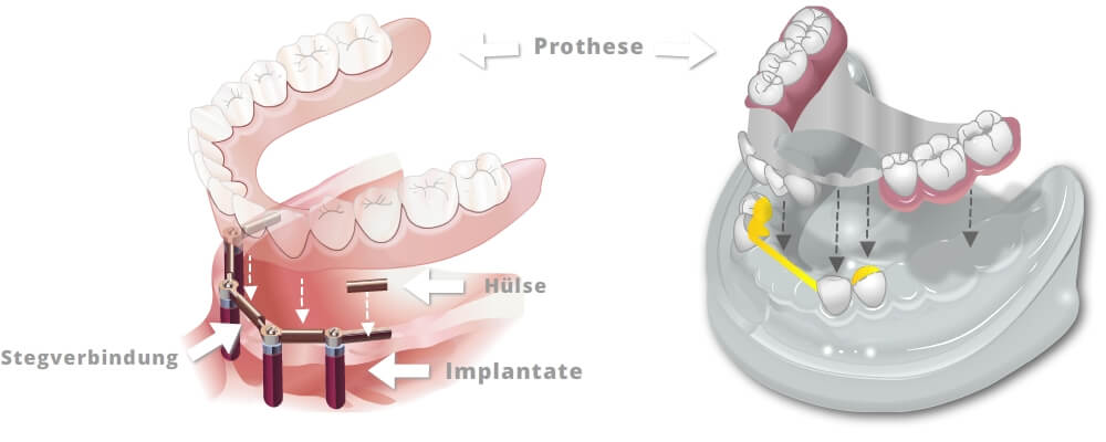 Teleskopprothese