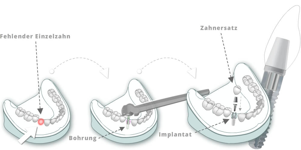 Einzelzahnversorgung