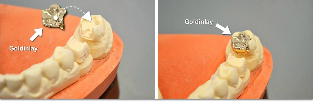 Gold Inlays