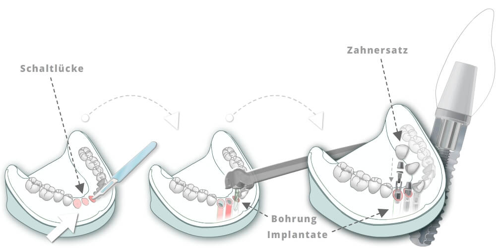 Schaltlücke