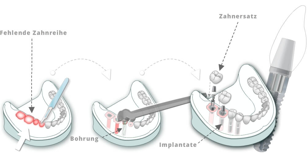 Zahnreihe