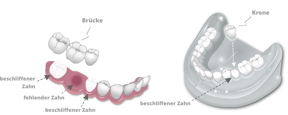 Vollkeramische Kronen und Brücken