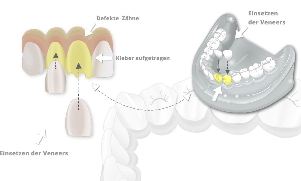 Keramik Veneers
