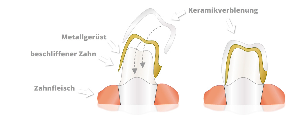 Citydental-Labor - Keramik - Verblendkrone
