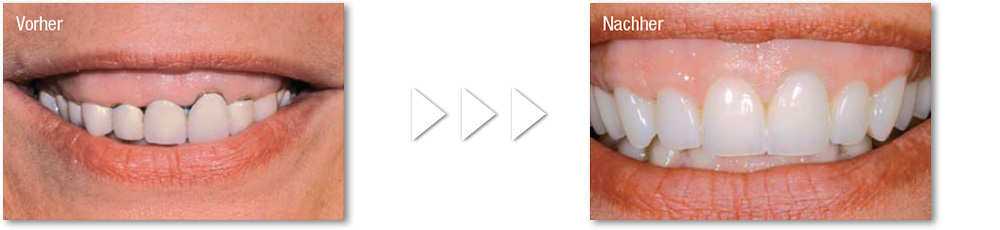 Citydental-Labor PRETTAU® ZIRKON