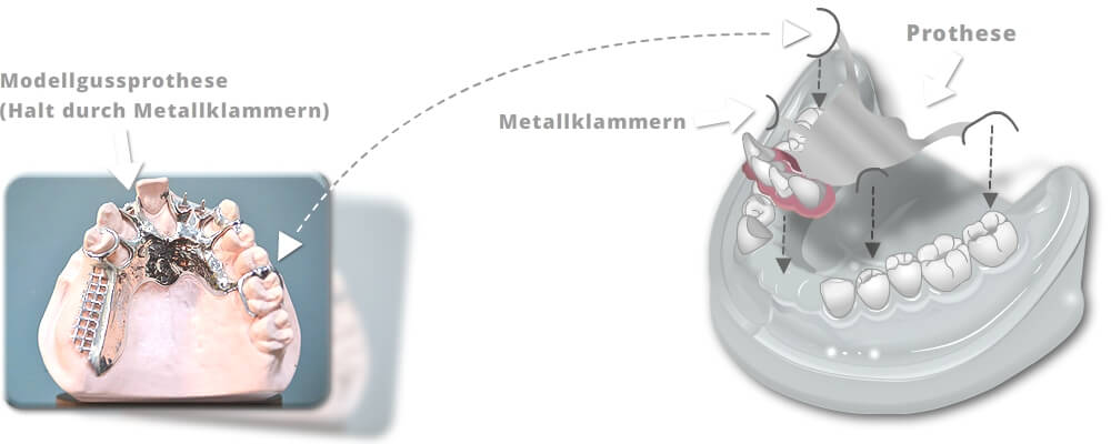 Teleskopprothese