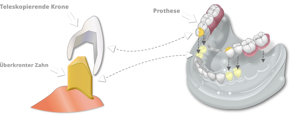 Teleskopprothese