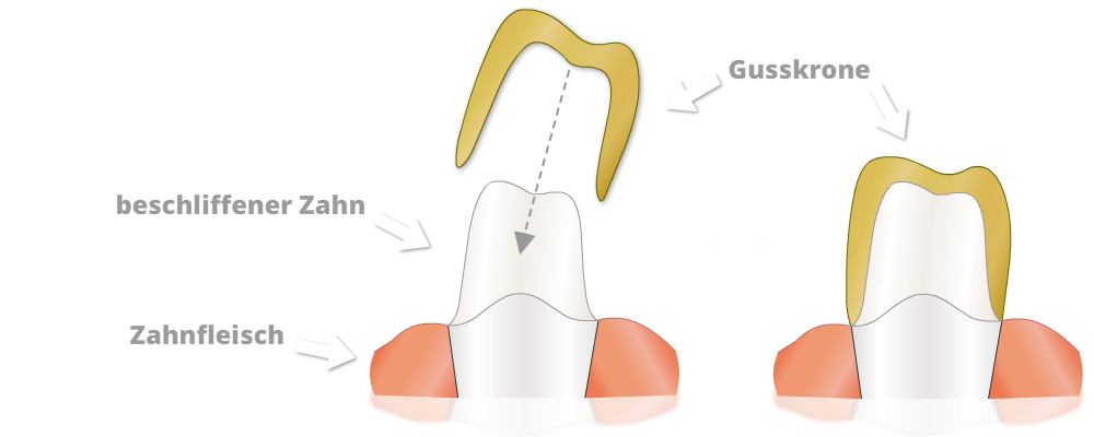 Citydental-Labor - Vollgusskrone