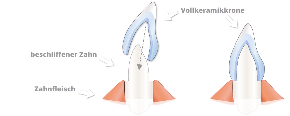 Citydental-Labor - Vollkeramikkrone